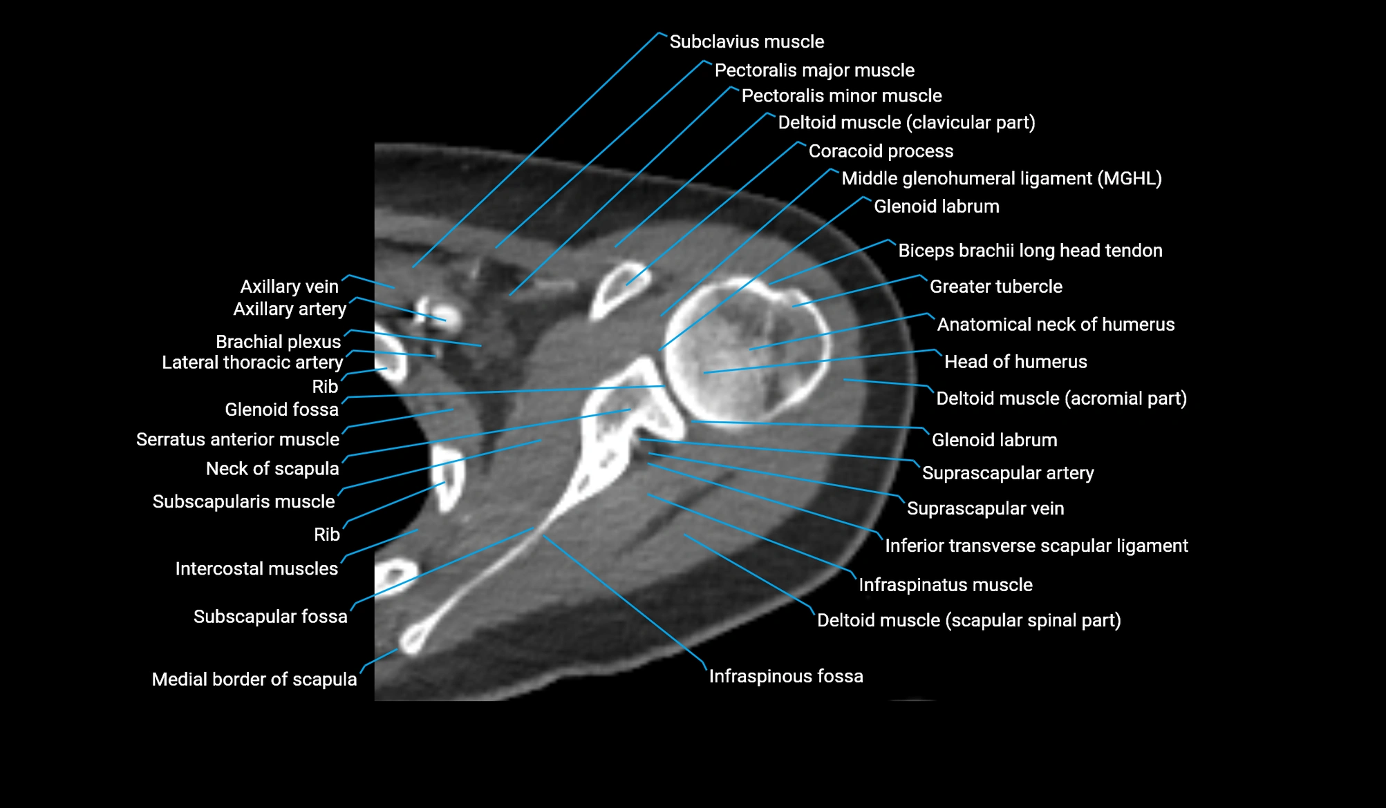 CT upper arm axial  cross sectional anatomy labelled radiology image -00088.webp